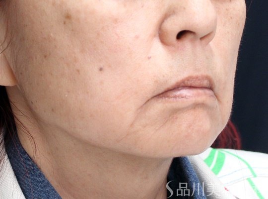 症例NO.70347のBEFORE写真