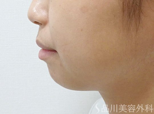 症例NO.74378のBEFORE写真
