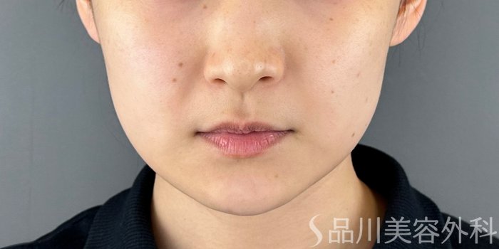 症例NO.70252のBEFORE写真