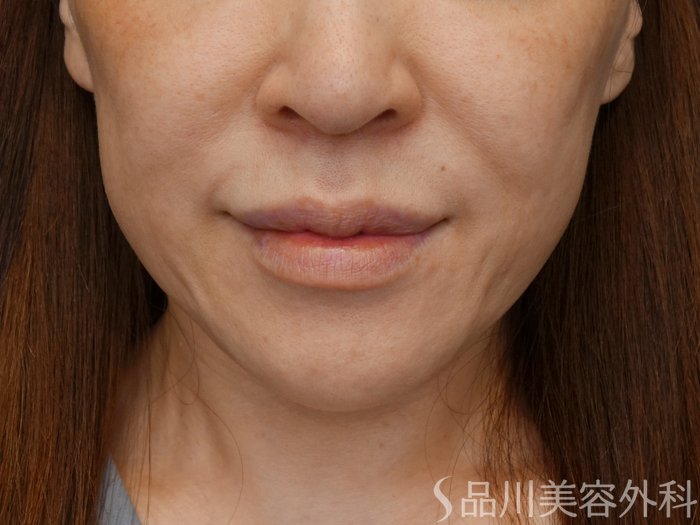 症例NO.71520のBEFORE写真