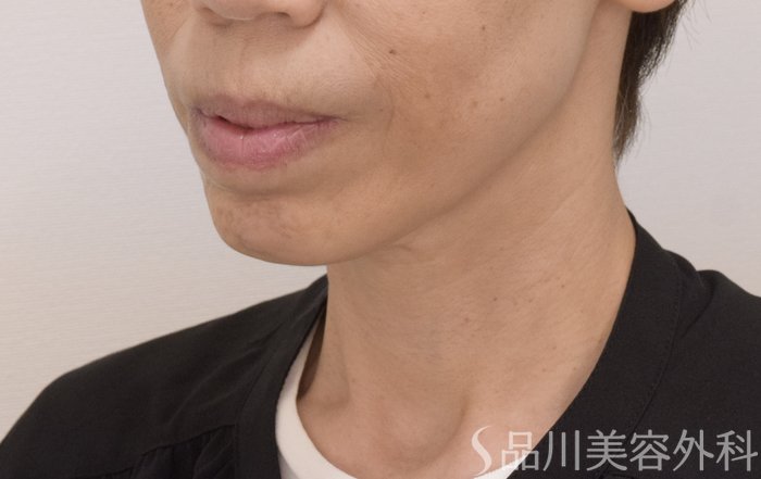 症例NO.71437のBEFORE写真