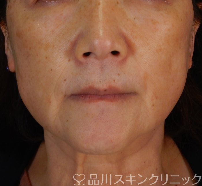 症例NO.65914のAFTER写真