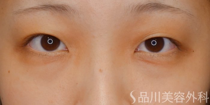 症例NO.73151のBEFORE写真