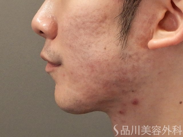 症例NO.72804のBEFORE写真