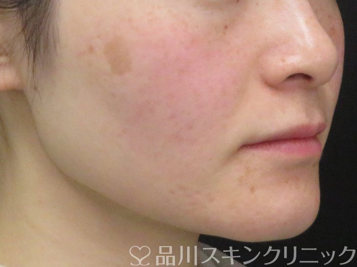 症例NO.74266のBEFORE写真