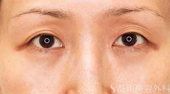 症例NO.61092のAFTER写真