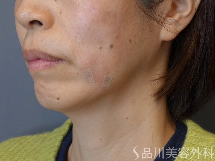 症例NO.72872のAFTER写真