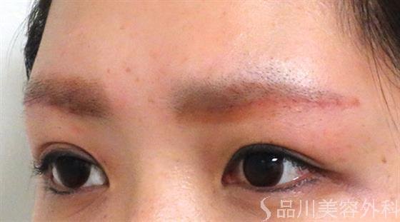 症例NO.26989のAFTER写真