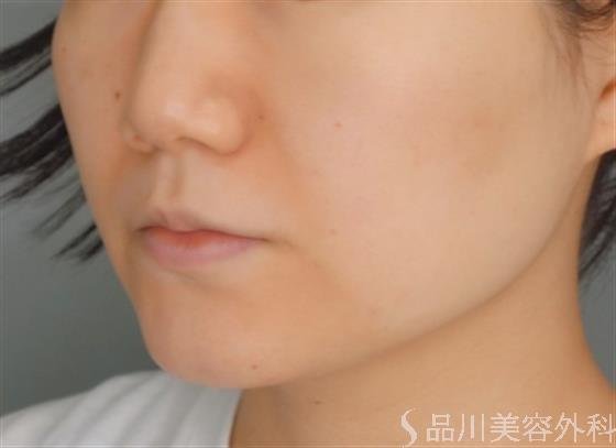 症例NO.51543のBEFORE写真