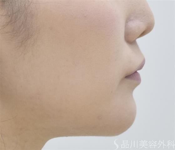 症例NO.44615のAFTER写真