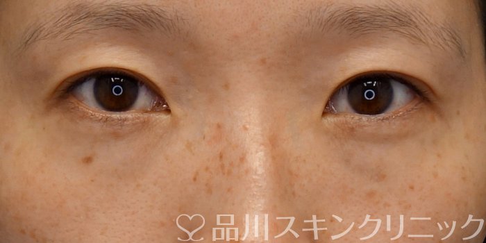 症例NO.73695のBEFORE写真