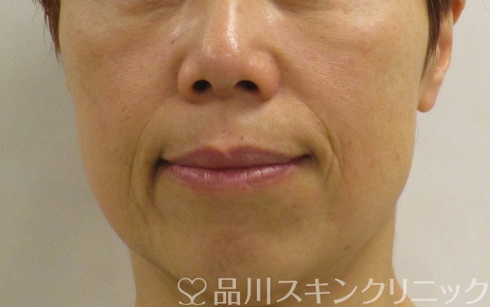 症例NO.64529のBEFORE写真