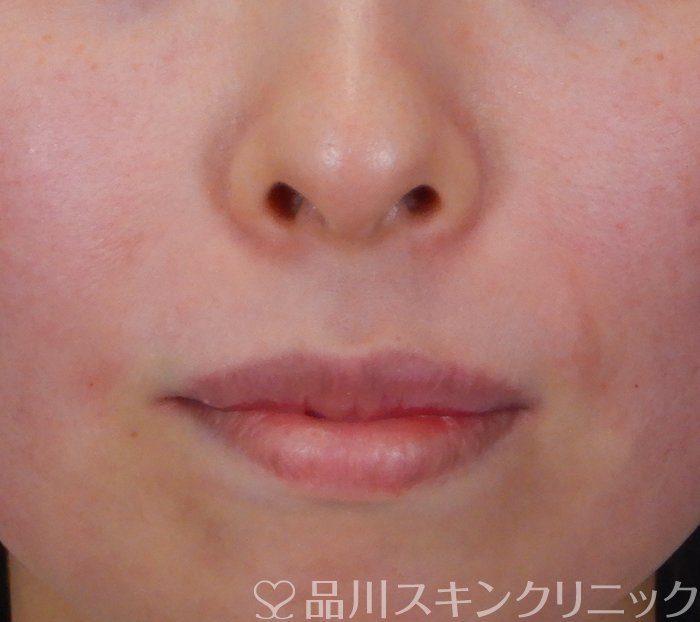 症例NO.66085のAFTER写真