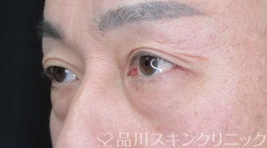 症例NO.69202のBEFORE写真