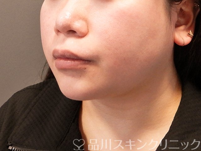 症例NO.70283のBEFORE写真