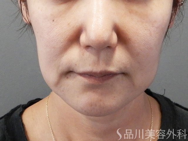 症例NO.71955のBEFORE写真