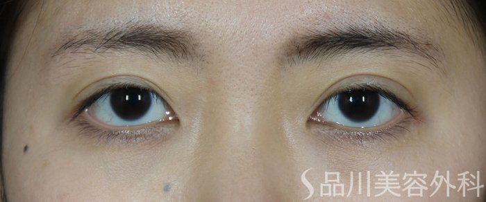 症例NO.65223のAFTER写真