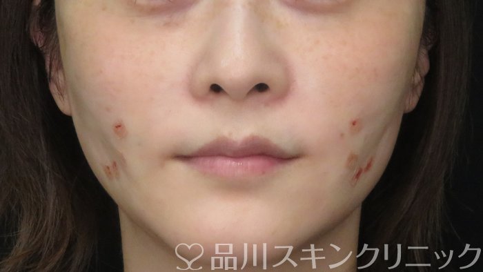 症例NO.71332のAFTER写真