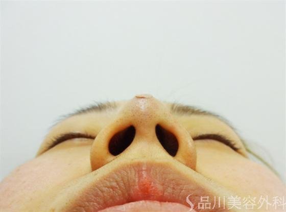 症例NO.16569のAFTER写真