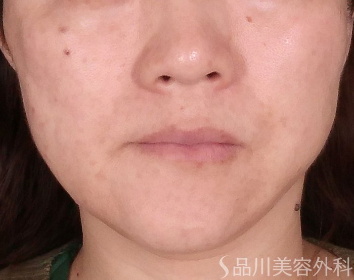 症例NO.70730のAFTER写真