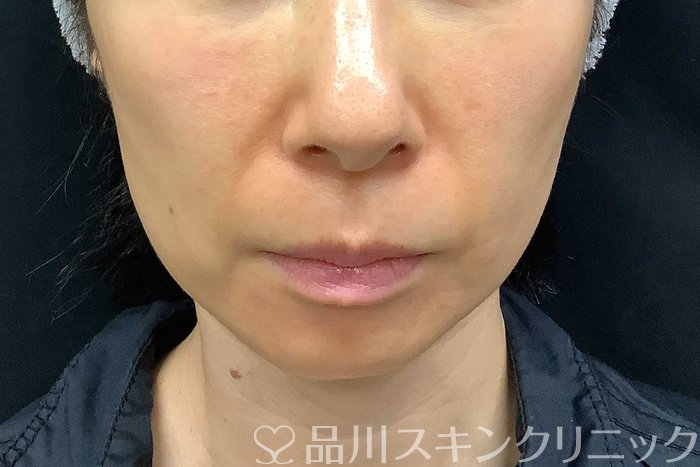 症例NO.69840のBEFORE写真