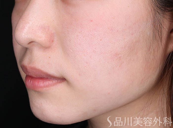 症例NO.72552のAFTER写真