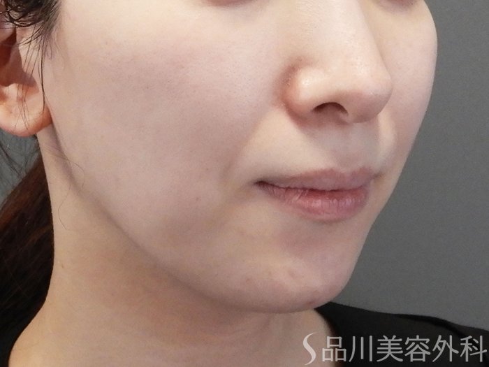 症例NO.70300のBEFORE写真
