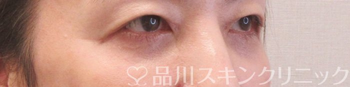症例NO.70229のAFTER写真