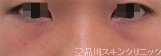 症例NO.31356のBEFORE写真