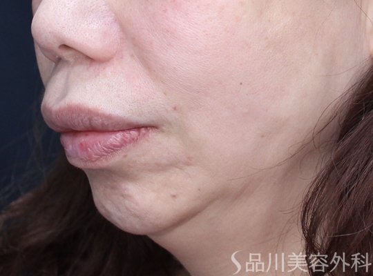 症例NO.73625のAFTER写真