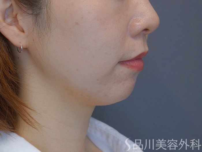 症例NO.74004のBEFORE写真