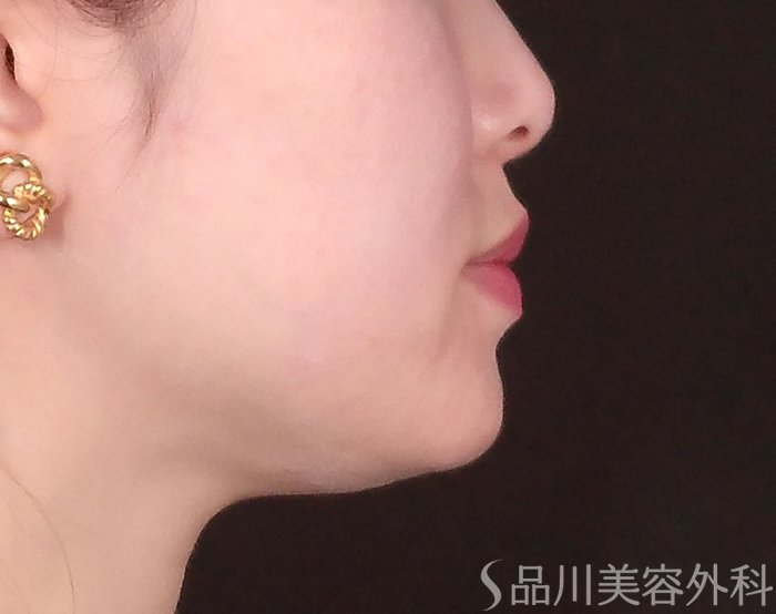 症例NO.69890のBEFORE写真