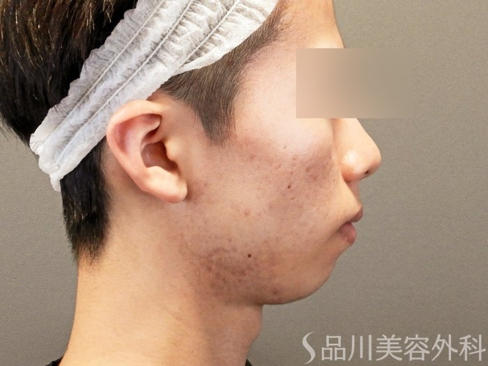 症例NO.65027のBEFORE写真