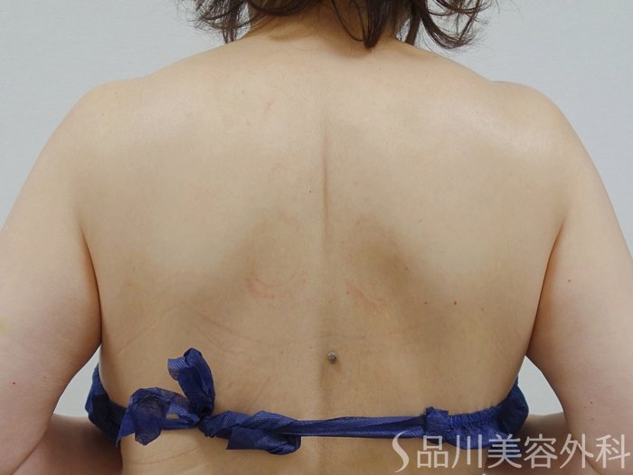 症例NO.73344のAFTER写真