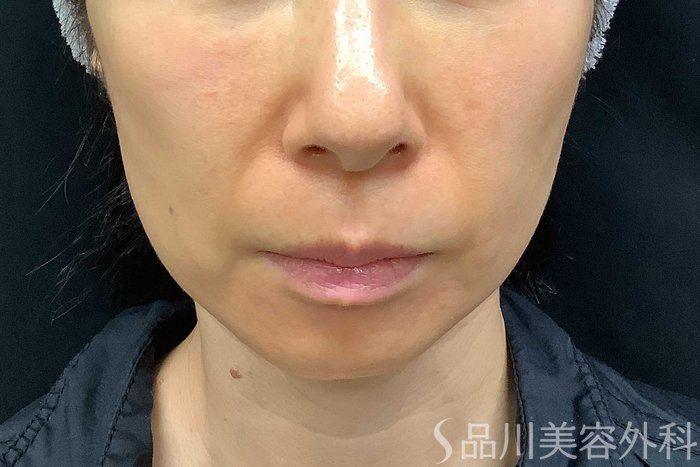 症例NO.69840のBEFORE写真