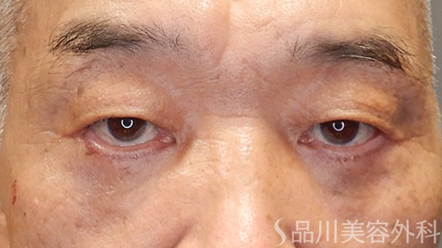症例NO.75223のAFTER写真