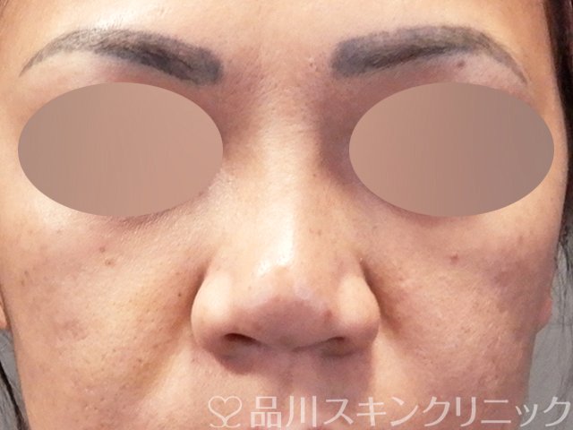 症例NO.67918のBEFORE写真