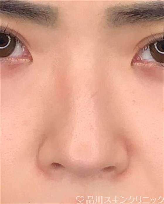 症例NO.52547のBEFORE写真