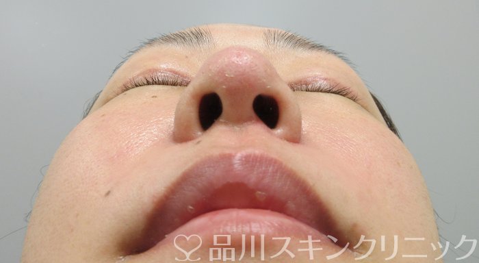 症例NO.74117のAFTER写真