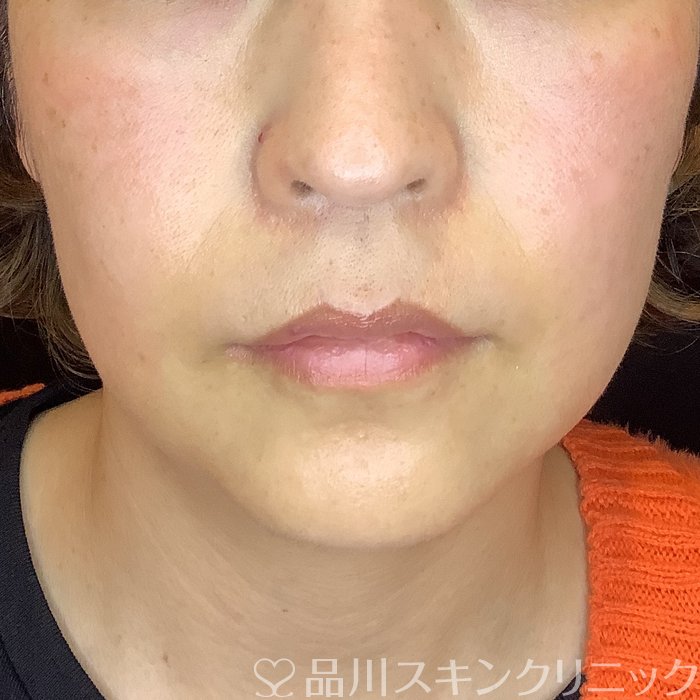 症例NO.64137のBEFORE写真