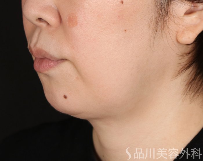 症例NO.74139のBEFORE写真