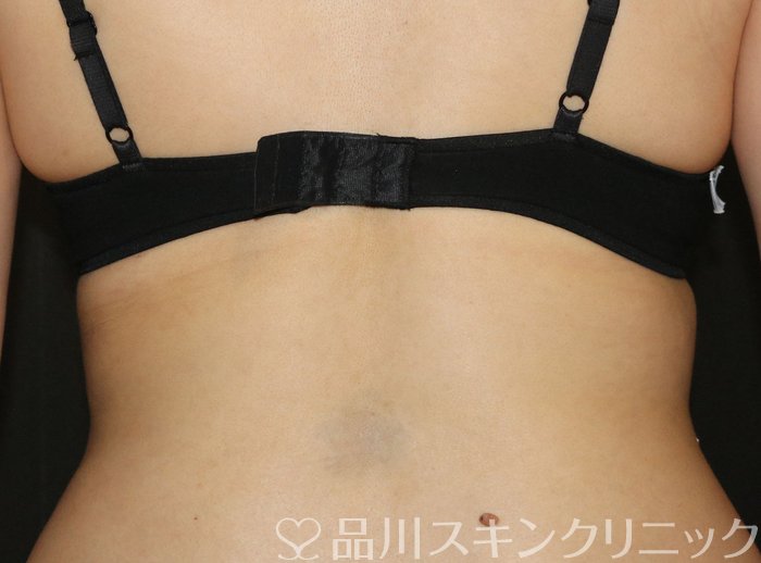 症例NO.70487のAFTER写真