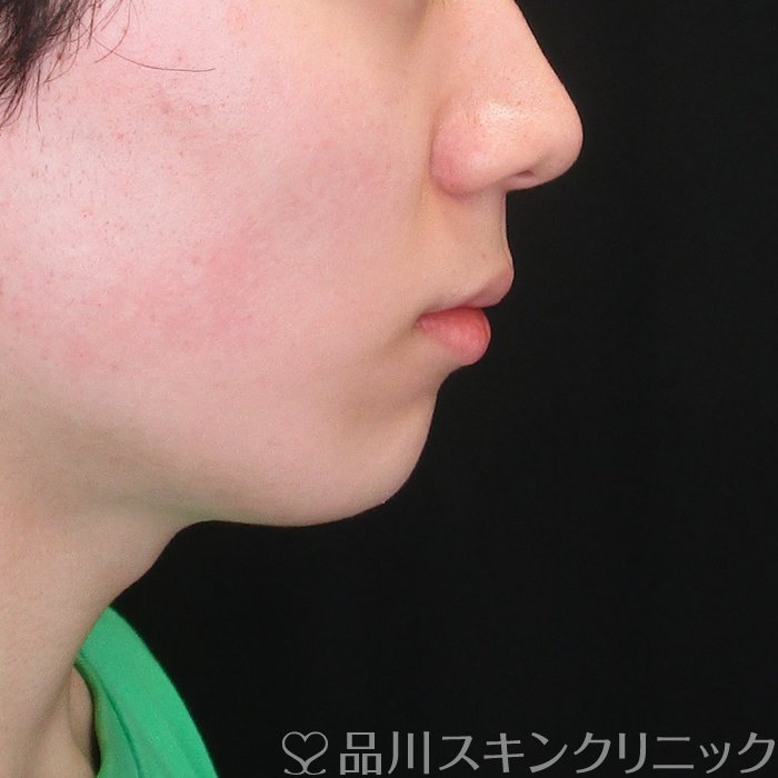 症例NO.73405のAFTER写真