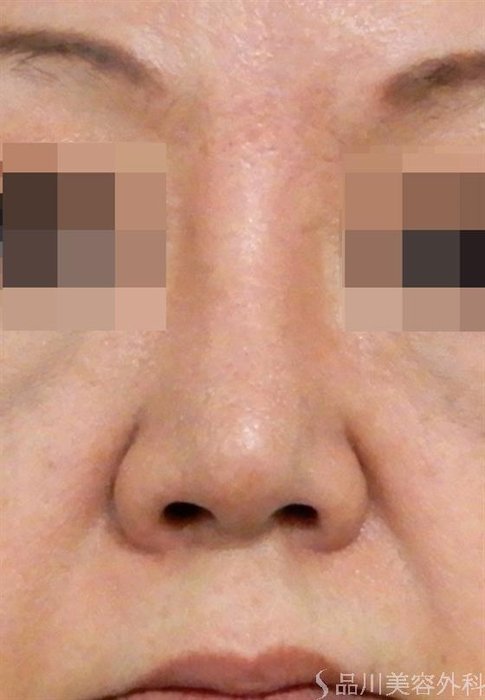症例NO.42215のAFTER写真