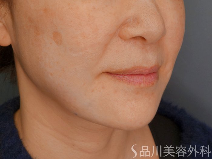 症例NO.73270のAFTER写真