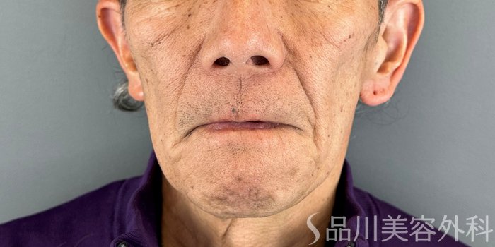 症例NO.74468のBEFORE写真