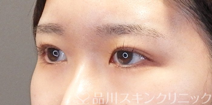 症例NO.63670のAFTER写真