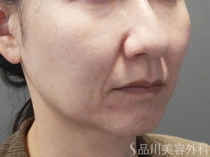 症例NO.72103のBEFORE写真