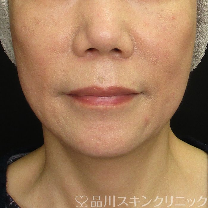 症例NO.69955のBEFORE写真