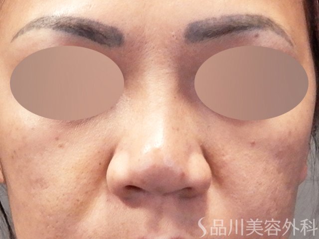 症例NO.67918のBEFORE写真